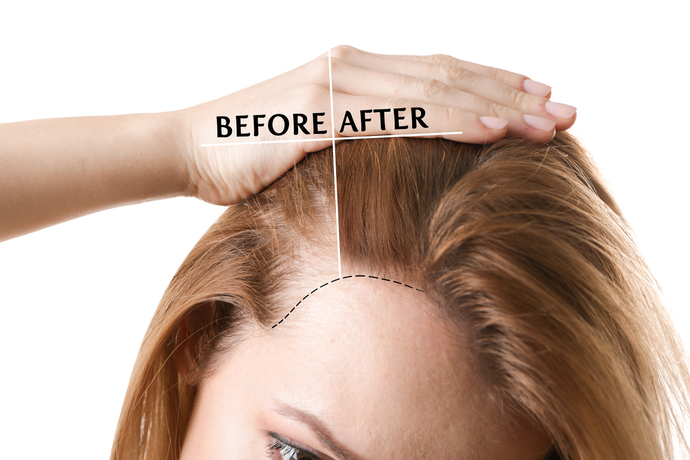 Alopecia por falta de estrógenos